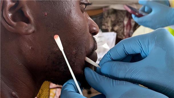 Experten-Warnung: Mpox könnte zu ernster Bedrohung werden Anders als die Pocken lassen sich Mpox nicht ganz ausrotten. (Archivbild)