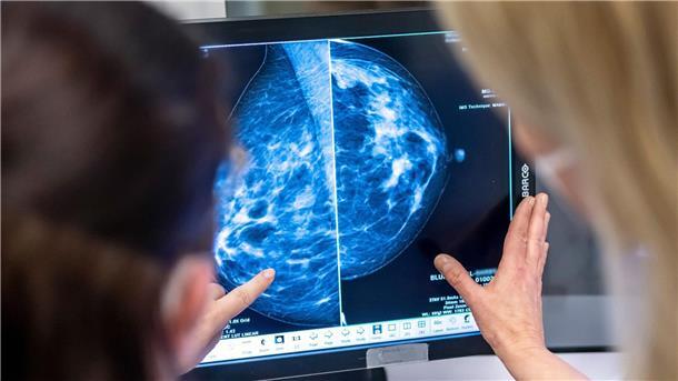 Zahl der Krebserkrankungen steigt weltweit Bei Frauen ist Brustkrebs die verbreitetste Form von Krebs.