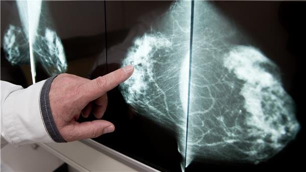 Beim Mammographie-Screening werden schon frühzeitig Veränderungen in der Brust, wie hier eine gutartige Fettzellen-Verkalkung, erkannt.