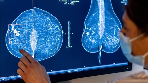 Brustkrebs-Früherkennung künftig bis 75 Jahre Brustkrebs ist die häufigste Krebserkrankung bei Frauen in Deutschland.