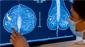 Brustkrebs ist die häufigste Krebserkrankung bei Frauen in Deutschland.