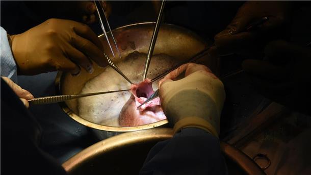 Schweineherz-Patient hat „Chance, dass er lange überlebt“ Chirurgen führen die Transplantation des Schweineherzens im Krankenhaus in Baltimore durch.