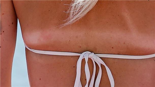 Streifen auf der Haut: besser nicht Der Abdruck des Bikiniträgers zeichnet sich von der gebräunten Haut ab - gesund ist das für die Haut aber nicht.