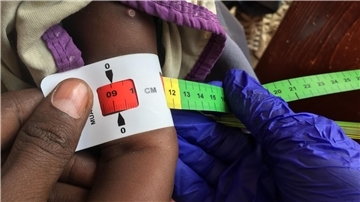 Der Armumfang eines schwer unterernährten Babys in Somalia wird gemessen. (Archivbild)