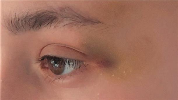 Blaues Auge