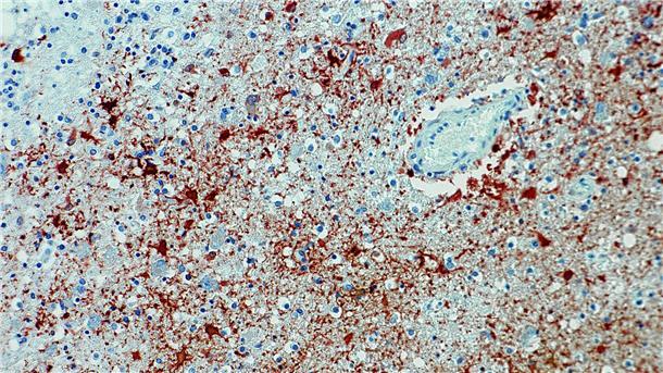 Mensch in Bayern mit Borna-Virus infiziert Die undatierte Aufnahme zeigt einen Anitkörpernachweis zum Borna-Virus im Gewebe.