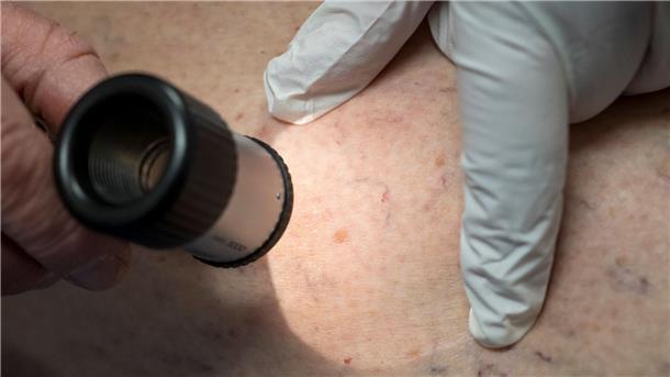 Wesentlich mehr in Kliniken behandelte Hautkrebsfälle Die Zahl der Krankenhausbehandlungen von Hautkrebs stieg enorm an. (Symbolbild)