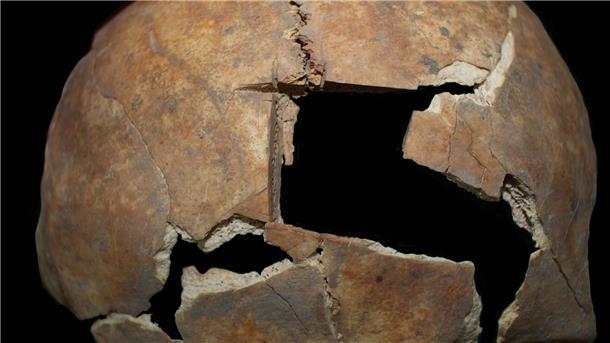 Mann vor etwa 3500 Jahren an Schädel operiert Diese Nahaufnahme zeigt den Schädel mit der Trepanation.
