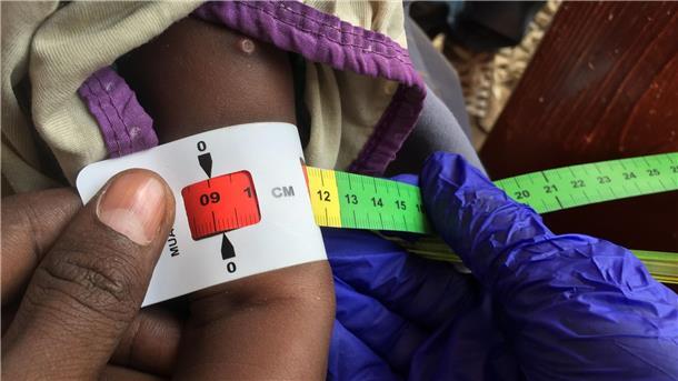 Unicef: Belagerter Ort im Sudan „Epizentrum des Kinderleids“ Ein Arzt misst im Sudan den Armumfang eines schwer unterernährten Babys (Archivbild)