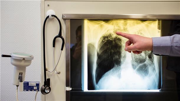 Wieder deutlicher Anstieg der Tuberkulose-Fälle Ein Arzt zeigt einen Tuberkulose-Fall anhand eines Röntgenbildes im Tuberkulosezentrum in Berlin.