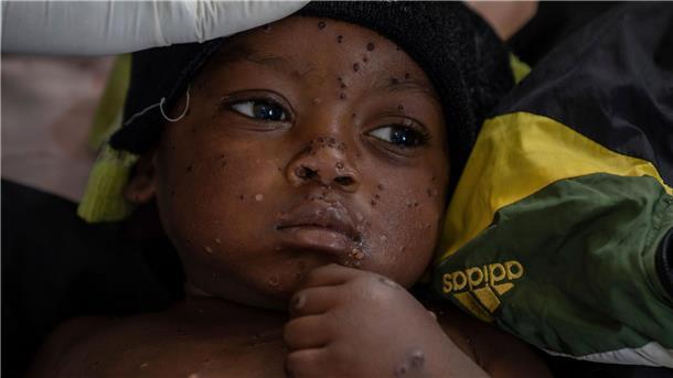 Experten-Warnung: Mpox könnte zu ernster Bedrohung werden Ein besorgniserregendes Risiko sehen die beiden Experten für Übertragungen zwischen Kindern. (Archivbild)
