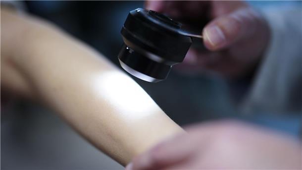 Verband fordert staatlich organisiertes Hautkrebs-Screening Ein Hautarzt untersucht bei einer Krebsvorsorgeuntersuchung eine Patientin mit einem Auflichtmikroskop.