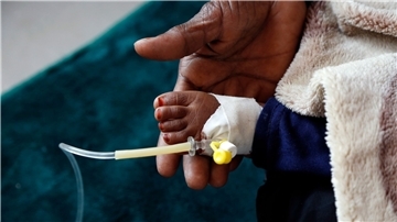 Ein mit Cholera infiziertes Kind erhält eine medizinische Behandlung.