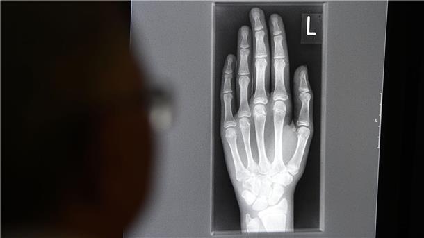 Medizinischer Revolutionär - Röntgen stirbt vor 100 Jahren Ein Röntgenbild auf einem Bildschirm zeigt in einem Klinikum in Baden-Württemberg die linke Hand eines jungen Menschen im Alter zwischen 16 und 19 Jahren.