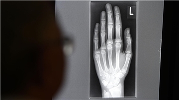 Ein Röntgenbild auf einem Bildschirm zeigt in einem Klinikum in Baden-Württemberg die linke Hand eines jungen Menschen im Alter zwischen 16 und 19 Jahren.