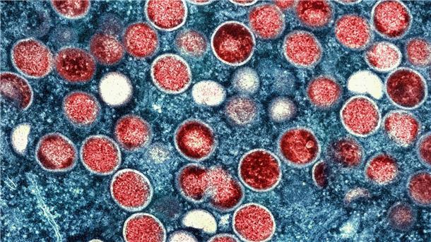 WHO warnt vor falscher Gelassenheit bei Affenpocken Eine eingefärbte Mikroskopaufnahme von mpox-Partikeln (rot) in einer infizierten Zelle (blau), die im Labor kultiviert wurde.