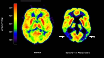 Entscheidung über die Zulassung für Medikament zur Behandlung von Alzheimer-Patienten verzögert sich. (Archivbild)