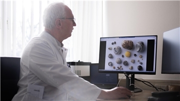  Dr. Frank P. Schulze zeigt, wie unterschiedlich Gallensteine aussehen können.