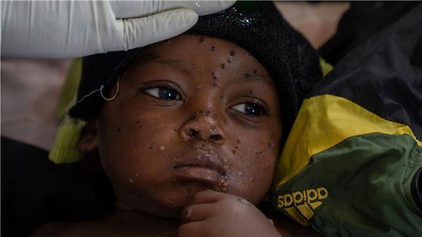 Zwei weitere Länder in Afrika melden Mpox Fachleute gehen von einer hohen Dunkelziffer bei den Infektionen aus. (Archivbild)