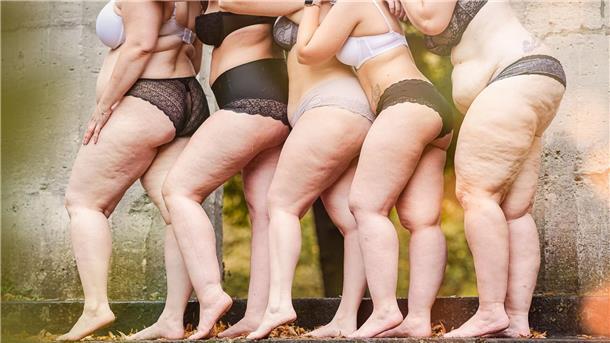 Frauen mit Lipödem-Erkrankung. Betroffene kämpfen für eine Ent-Stigmatisierung der Krankheit und fordern mehr kompetente Ärzte.