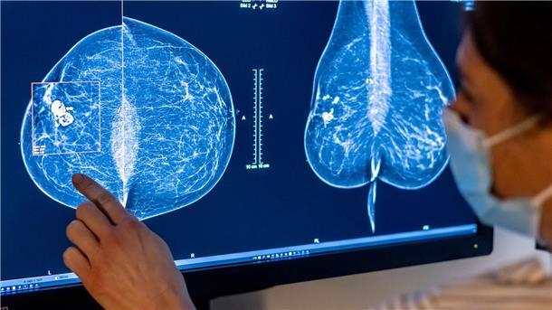 Für Frauen gibt es eine spezielle Untersuchung, um Krebs früh zu entdecken: die Mammografie. (Archivbild)