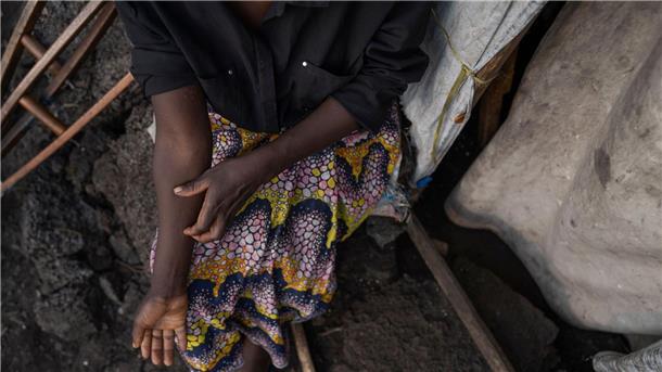 Behörde: Mehr Mpox-Fälle in Europa zu erwarten In Afrika gibt es schon 14.000 Mpox-Verdachtsfälle.