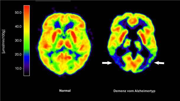 EU-Kommission lässt Wirkstoff Lecanemab gegen Alzheimer zu Lecanemab richtet sich gegen Amyloid-Ablagerungen im Gehirn und soll dadurch den Verlauf der Krankheit ein wenig verlangsamen. (Archivbild)