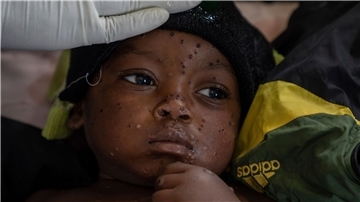 Neue Tests sollen die Ausbreitung von Mpox eindämmen helfen. (Archivbild)