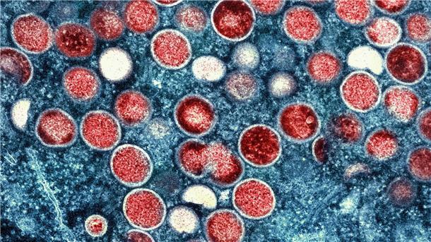 Experten-Warnung: Mpox könnte zu ernster Bedrohung werden Überlässt die Welt die Zukunft von Mpox der Natur und dem Zufall? (Archivbild)